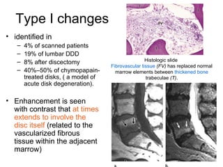 Type I changes 
• identified in 
– 4% of scanned patients 
– 19% of lumbar DDD 
– 8% after discectomy 
– 40%–50% of chymopapain-treated 
disks, ( a model of 
acute disk degeneration). 
• Enhancement is seen 
with contrast that at times 
extends to involve the 
disc itself (related to the 
vascularized fibrous 
tissue within the adjacent 
marrow) 
Histologic slide 
Fibrovascular tissue (FV) has replaced normal 
marrow elements between thickened bone 
trabeculae (T). 
 