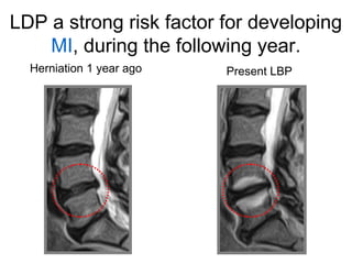 LDP a strong risk factor for developing 
MI, during the following year. 
Herniation 1 year ago Present LBP 
 