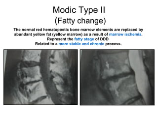 Modic Type II 
(Fatty change) 
The normal red hematopoetic bone marrow elements are replaced by 
abundant yellow fat (yellow marrow) as a result of marrow ischemia. 
Represent the fatty stage of DDD 
Related to a more stable and chronic process. 
 