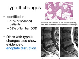 Type II changes 
• Identified in 
– 16% of scanned 
patients 
– 59% of lumbar DDD 
• Discs with type II 
changes also show 
evidence of 
endplate disruption 
Increased lipid content of the marrow space (L). 
Note also thickened woven bone trabeculae (T). 
 