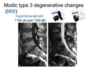 Modic type 3 degenerative changes 
(MIII) 
Hypointense on both 
T1WI (A) and T2WI (B) 
 