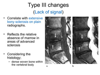 Type III changes 
(Lack of signal) 
• Correlate with extensive 
bony sclerosis on plain 
radiographs. 
• Reflects the relative 
absence of marrow in 
areas of advanced 
sclerosis 
• Considering the 
histology; 
– dense woven bone within 
the vertebral body 
 
