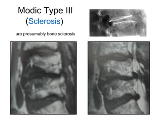 Modic Type III 
(Sclerosis) 
are presumably bone sclerosis 
 