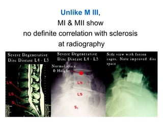 Unlike M III, 
MI & MII show 
no definite correlation with sclerosis 
at radiography 
 