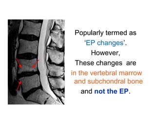 Popularly termed as 
‘EP changes’. 
However, 
These changes are 
in the vertebral marrow 
and subchondral bone 
and not the EP. 
 