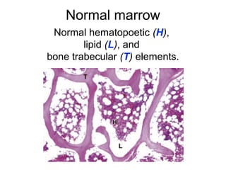 Normal marrow 
Normal hematopoetic (H), 
lipid (L), and 
bone trabecular (T) elements. 
 