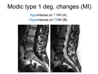 Modic type 1 deg. changes (MI) 
Hypointense on T1WI (A) 
Hyperintense on T2WI (B) 
 
