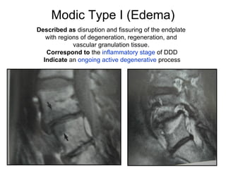 Modic Type I (Edema) 
Described as disruption and fissuring of the endplate 
with regions of degeneration, regeneration, and 
vascular granulation tissue. 
Correspond to the inflammatory stage of DDD 
Indicate an ongoing active degenerative process 
 