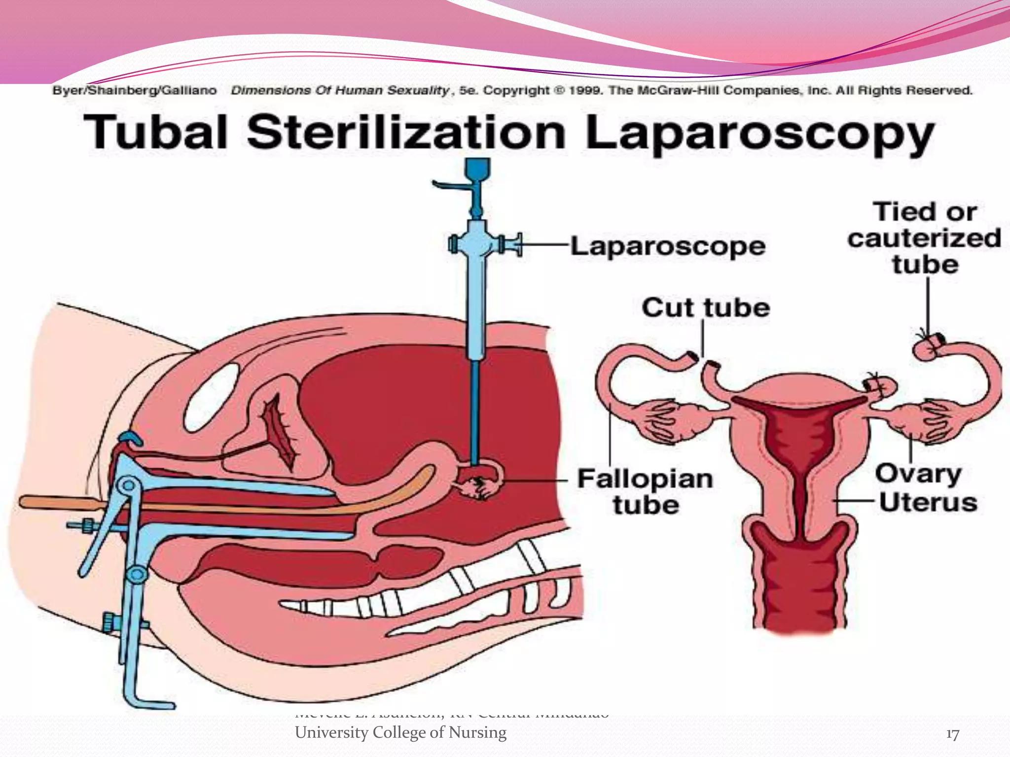 Mevelle L. Asuncion, RN Central Mindanao
University College of Nursing              17
 