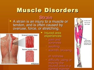 Muscle DisordersMuscle Disorders
 A strain is an injury to a muscle orA strain is an injury to a muscle or
tendon, and is often caused bytendon, and is often caused by
overuse, force, or stretching.overuse, force, or stretching.
 Injured areaInjured area
experiences:experiences:
 pain andpain and
sorenesssoreness
 swellingswelling
 warmth, bruising,warmth, bruising,
or rednessor redness
 difficulty using ordifficulty using or
moving themoving the
injured area in ainjured area in a
normal manner
StrainStrain
 