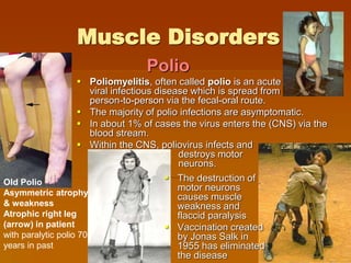 Muscle Disorders
 Poliomyelitis, often called polio is an acute
viral infectious disease which is spread from
person-to-person via the fecal-oral route.
 The majority of polio infections are asymptomatic.
 In about 1% of cases the virus enters the (CNS) via the
blood stream.
 Within the CNS, poliovirus infects and
destroys motor
neurons.
Polio
Old Polio
Asymmetric atrophy
& weakness
Atrophic right leg
(arrow) in patient
with paralytic polio 70
years in past
 The destruction of
motor neurons
causes muscle
weakness and
flaccid paralysis
 Vaccination created
by Jonas Salk in
1955 has eliminated
the disease
 