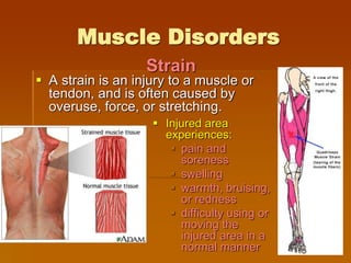 Muscle Disorders
 A strain is an injury to a muscle or
tendon, and is often caused by
overuse, force, or stretching.
 Injured area
experiences:
 pain and
soreness
 swelling
 warmth, bruising,
or redness
 difficulty using or
moving the
injured area in a
normal manner
Strain
 