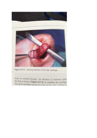 The nasal tip & nasolabial angle