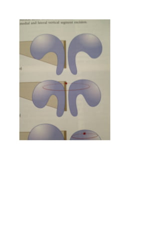 The nasal tip & nasolabial angle