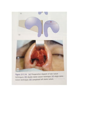 The nasal tip & nasolabial angle