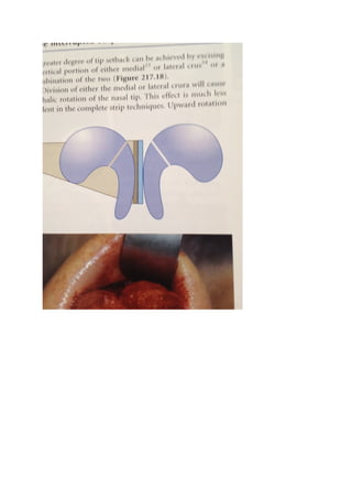 The nasal tip & nasolabial angle