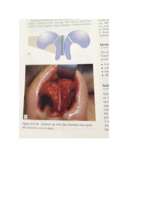 The nasal tip & nasolabial angle