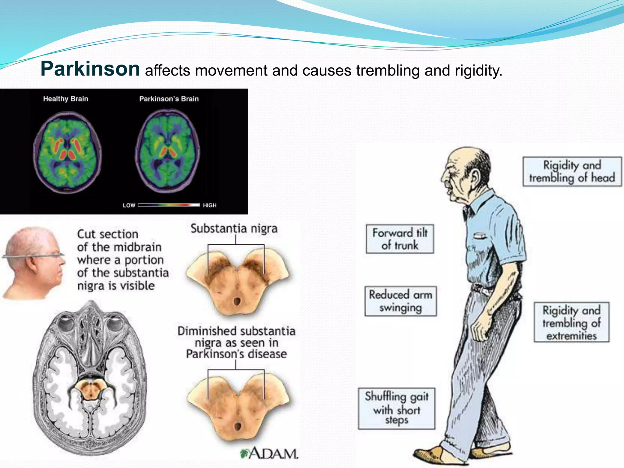 Parkinson affects movement and causes trembling and rigidity.
 