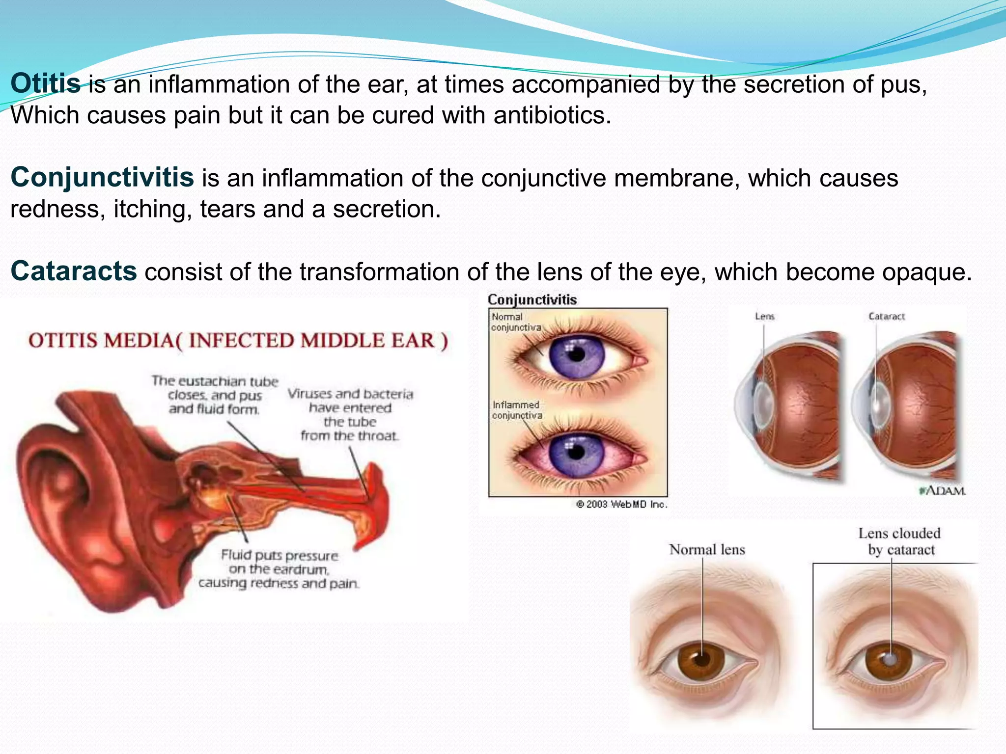 Otitis is an inflammation of the ear, at times accompanied by the secretion of pus,
Which causes pain but it can be cured with antibiotics.
Conjunctivitis is an inflammation of the conjunctive membrane, which causes
redness, itching, tears and a secretion.
Cataracts consist of the transformation of the lens of the eye, which become opaque.
 