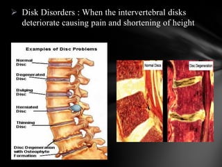  Disk Disorders : When the intervertebral disks
deteriorate causing pain and shortening of height
 