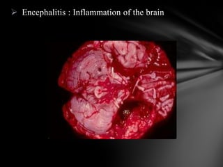  Encephalitis : Inflammation of the brain
 