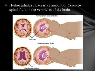  Hydrocephalus : Excessive amount of Cerebro-
spinal fluid in the ventricles of the brain
 