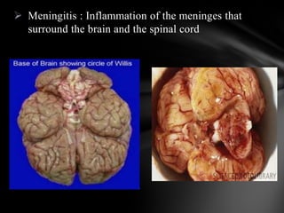  Meningitis : Inflammation of the meninges that
surround the brain and the spinal cord
 