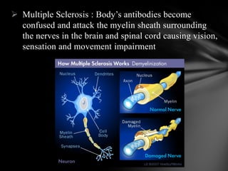  Multiple Sclerosis : Body’s antibodies become
confused and attack the myelin sheath surrounding
the nerves in the brain and spinal cord causing vision,
sensation and movement impairment
 
