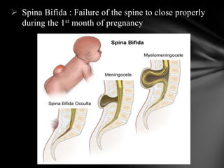  Spina Bifida : Failure of the spine to close properly
during the 1st month of pregnancy
 