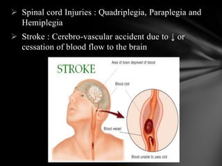  Spinal cord Injuries : Quadriplegia, Paraplegia and
Hemiplegia
 Stroke : Cerebro-vascular accident due to ↓ or
cessation of blood flow to the brain
 