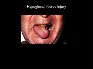 Hypoglossal Nerve Injury 