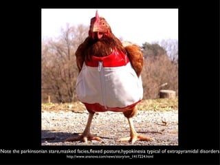 Note the parkinsonian stare,masked facies,flexed posture,hypokinesia typical of extrapyramidal disorders  http://www.ananova.com/news/story/sm_1417224.html 