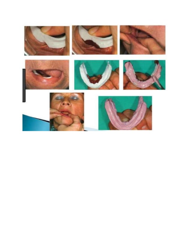 The neutral zone concept in complete denture final