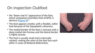 On inspection Clubfoot
• the “down and in” appearance of the foot,
which somewhat resembles that of MTA, is
obvious (Figure 5).3
• The foot appears smaller, with a flexible, softer
heel because of the hypoplastic calcaneus.
• The medial border of the foot is concave with a
deep medial skin furrow, and the lateral border
is highly convex.
• The heel is usually small and is internally
rotated, making the soles of the feet face each
other in cases of bilateral deformities.
 