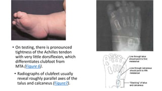 • On testing, there is pronounced
tightness of the Achilles tendon
with very little dorsiflexion, which
differentiates clubfoot from
MTA (Figure 6).
• Radiographs of clubfeet usually
reveal roughly parallel axes of the
talus and calcaneus (Figure7).
 