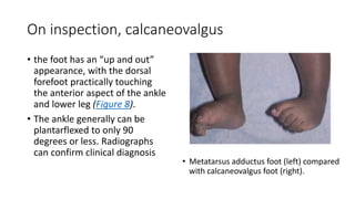 On inspection, calcaneovalgus
• the foot has an “up and out”
appearance, with the dorsal
forefoot practically touching
the anterior aspect of the ankle
and lower leg (Figure 8).
• The ankle generally can be
plantarflexed to only 90
degrees or less. Radiographs
can confirm clinical diagnosis
• Metatarsus adductus foot (left) compared
with calcaneovalgus foot (right).
 