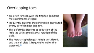 Overlapping toes
• are often familial, with the fifth toe being the
most commonly affected.
• Frequently bilateral, the condition is distributed
evenly between boys and girls.
• This deformity presents as adduction of the
little toe with some external rotation of the
digit.
• The metatarsophalangeal joint is dorsiflexed,
and the nail plate is frequently smaller than
expected.15
 