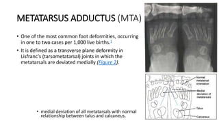 METATARSUS ADDUCTUS (MTA)
• One of the most common foot deformities, occurring
in one to two cases per 1,000 live births.1
• It is defined as a transverse plane deformity in
Lisfranc's (tarsometatarsal) joints in which the
metatarsals are deviated medially (Figure 2).
• medial deviation of all metatarsals with normal
relationship between talus and calcaneus.
 