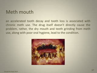 Donald W. Reid 2014
37
Meth mouth
an accelerated tooth decay and tooth loss is associated with
chronic meth use. The drug itself doesn’t directly cause the
problem, rather, the dry mouth and teeth grinding from meth
use, along with poor oral hygiene, lead to the condition.
 