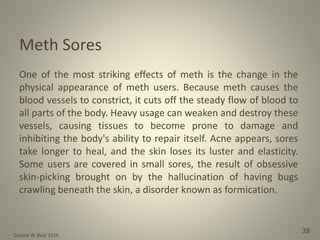 Donald W. Reid 2014
38
Meth Sores
One of the most striking effects of meth is the change in the
physical appearance of meth users. Because meth causes the
blood vessels to constrict, it cuts off the steady flow of blood to
all parts of the body. Heavy usage can weaken and destroy these
vessels, causing tissues to become prone to damage and
inhibiting the body's ability to repair itself. Acne appears, sores
take longer to heal, and the skin loses its luster and elasticity.
Some users are covered in small sores, the result of obsessive
skin‐picking brought on by the hallucination of having bugs
crawling beneath the skin, a disorder known as formication.
 