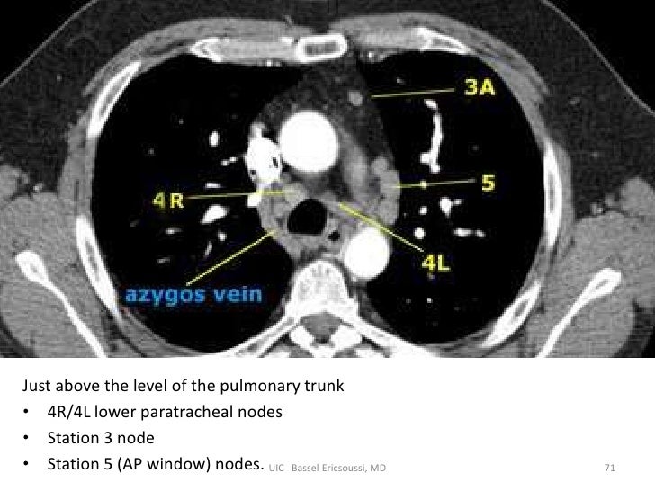 Лимфоузлы легких на кт схема