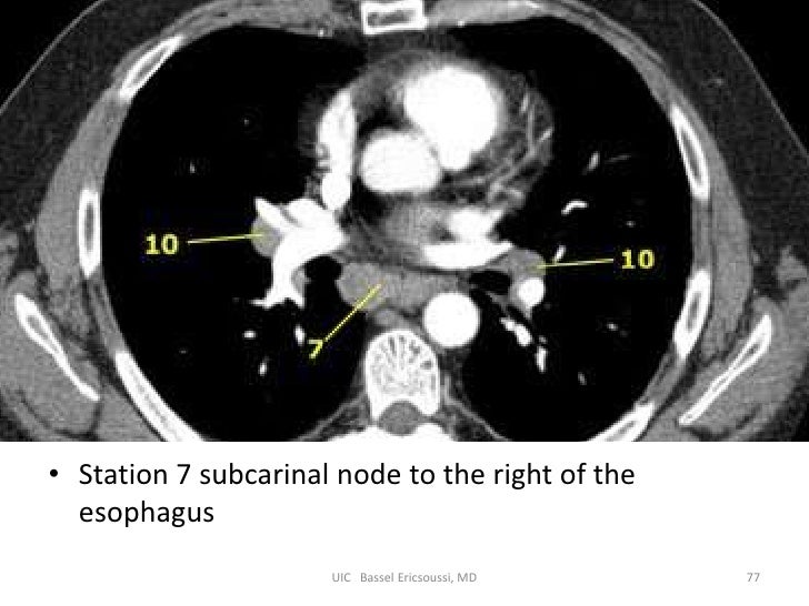 Лимфоузлы легких на кт схема