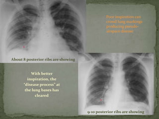 Inspiration Normal Ribs The normal chest BY Dr Nikhil Bansal | PPTX