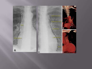 CarinaMediastinumCentral with aortic knuckle to the left and SVC to the right