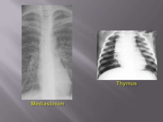 Intraluminal ‘things’