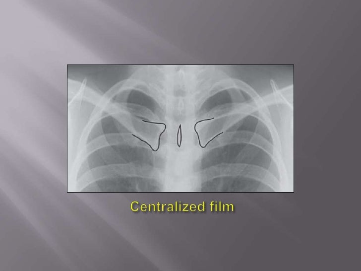 The Normal Chest X Ray