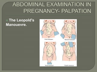  The
    Leopold's
Manouevre.
 