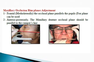 The occlusal rims and record