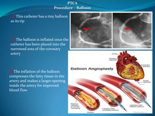 PTCA | PPTX