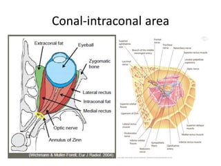 Conal-intraconal area
 
